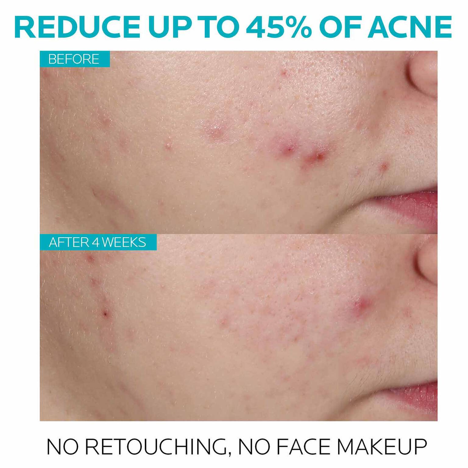 effaclar-salicylic-acid-acne-treatment-serum-u5 7_EffaclarSerum_After-45-days.jpg