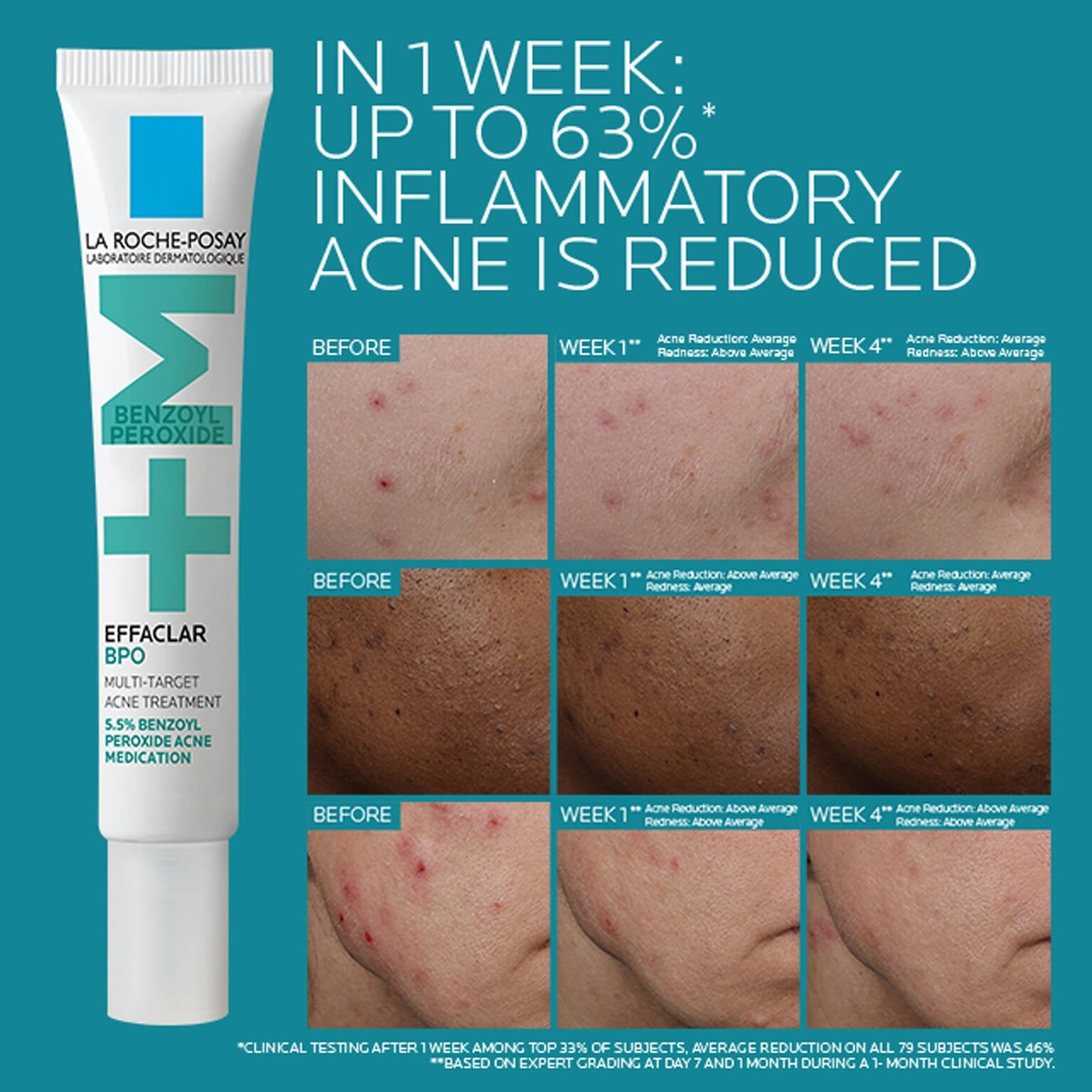 effaclar-bpo-multi-target-acne-treatment-with-5-5-benzoyl-peroxide-l1 EffaclarBPO-ClinicalBA-ATF-1500x1500-2.jpg