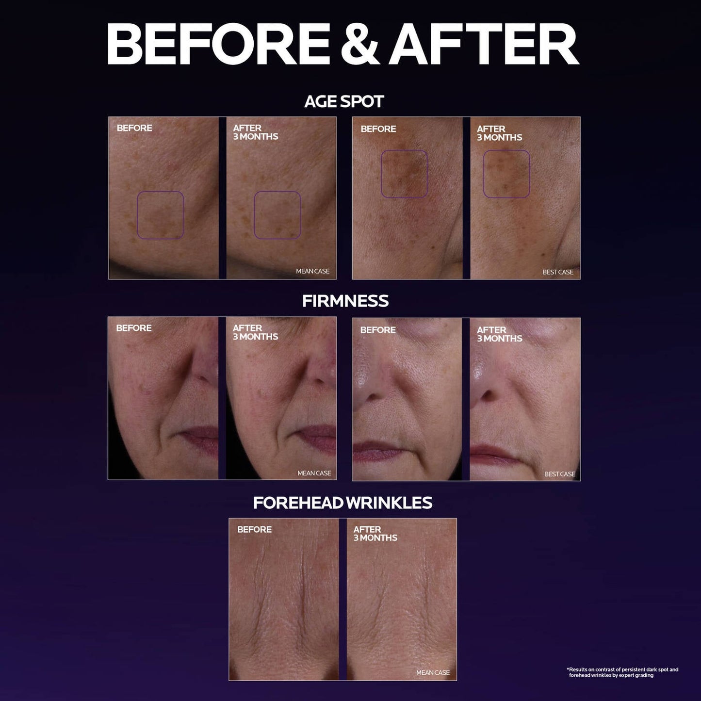 mela-b3-double-dose-discoloration-treatment-with-melasyltm-i8 MelaB3_DD_BTF_BeforeAfter_1500x1500_5.jpg