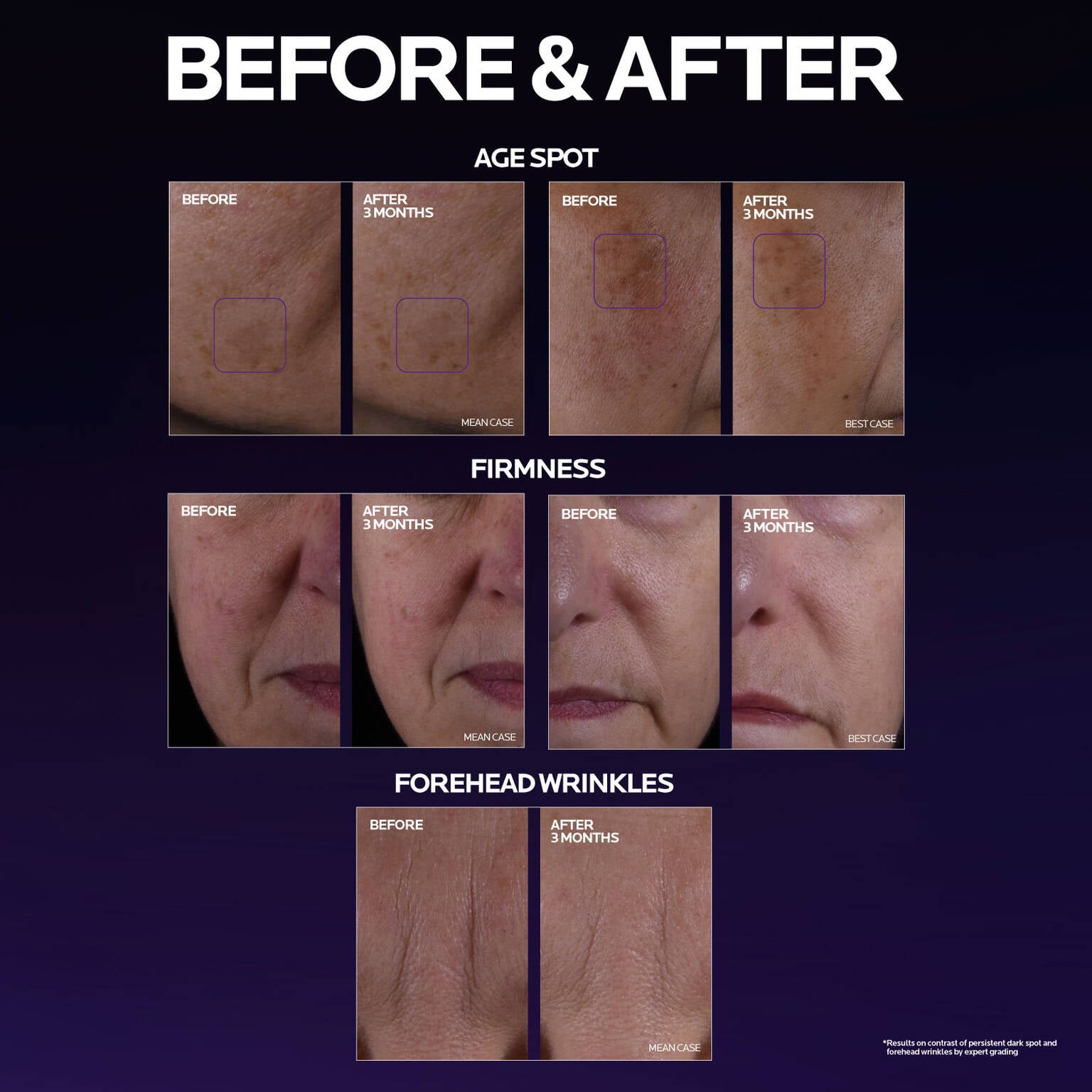 mela-b3-double-dose-discoloration-treatment-with-melasyltm-i8 MelaB3_DD_BTF_BeforeAfter_1500x1500_5.jpg
